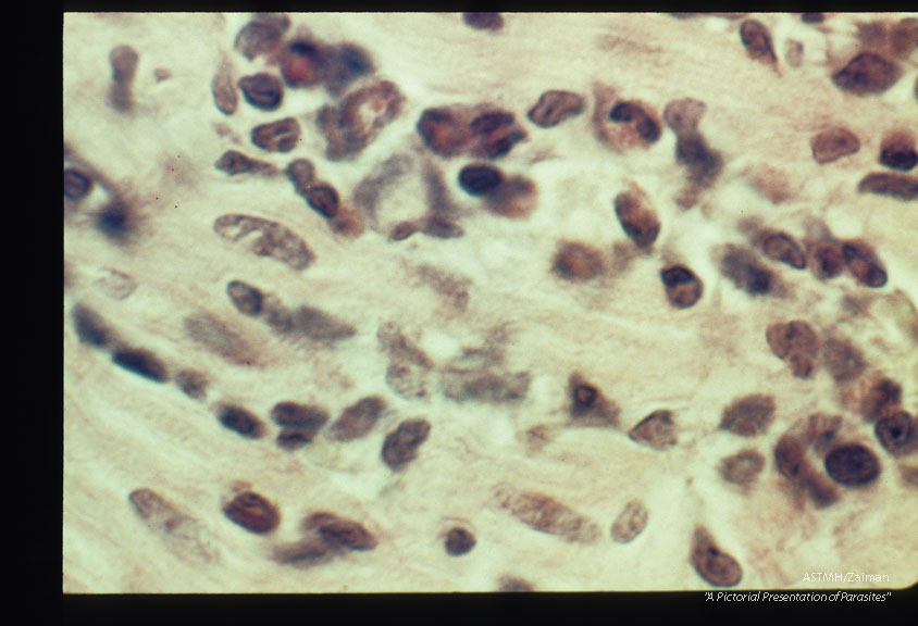 Focal myocardial lesions at low and high powers. Experimental trichinous myocarditis in rats.