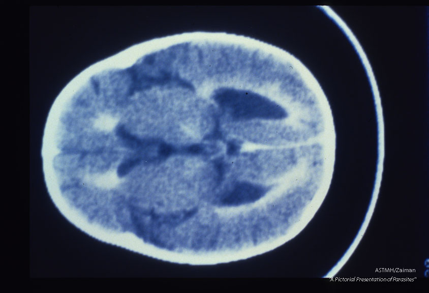 Samecase. Contrast enhanced CT brain scans show ventricular dilatation, periventricular enhance­ment and enlargement of cortical sulci.