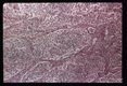 Hematoxylin-eosin stained sections of lymph gland showing adenitis associated with infection.