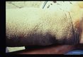 Heavy cobblestone hyperkeratosis and elephantiasis of the left leg of a forty-four year old female. Case was acquired thirty-two years earlier.