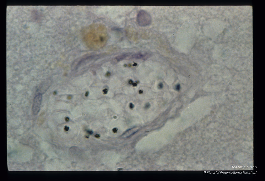 Parasites in brain capillary.