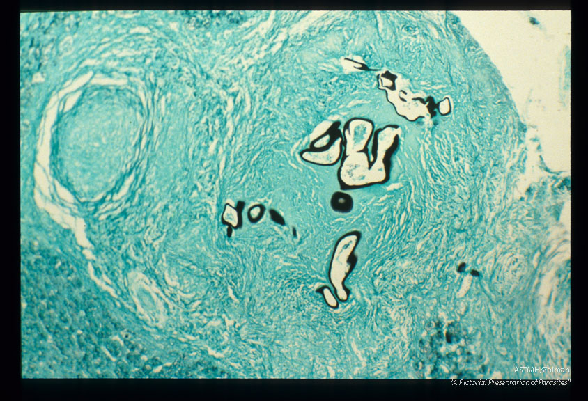 Gross and microscopic photos of human liver from Minnesota where about one half of the red foxes are infected.