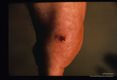 Lesion on the medial aspect of a medical missionary's foot prior to and after extraction (2194) of the flea.