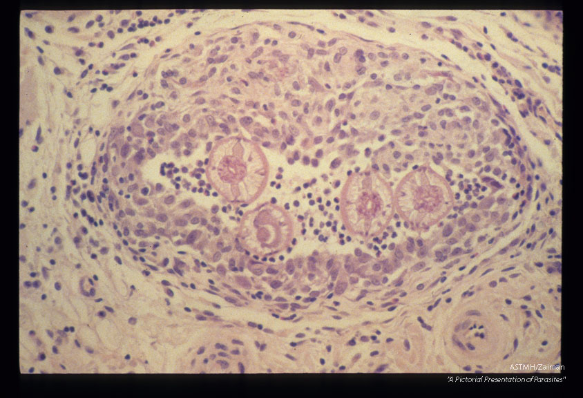 Larval granuloma in myocardium of an experimentally infected squirrel monkey.