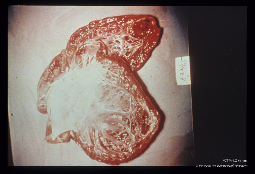 Gross pathology. Opened heart showing myocarditis in Chagas' disease.