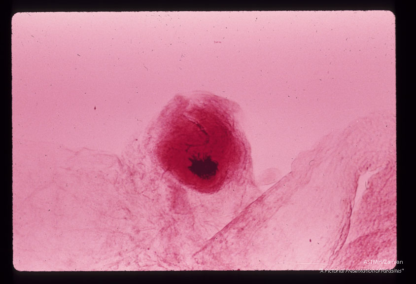 A 32 month old white male in South Dakota suffered progressive lassitude,   anorexia,   irritability,   incoordination and infrequent vomiting.  A suboccipital craniotomy was performed during which a grape-like mass of translucent thin wall cysts was discovered and partially evacuated with difficulty.  Subsequently patient developed flexion rigidity of the  extremities,  non-reactive pupils and decreased consciousness.  A sinus tract at the operative site con­tained more cysts.  The patient died three months after the onset of symptoms.  Higher power views of one scolex.