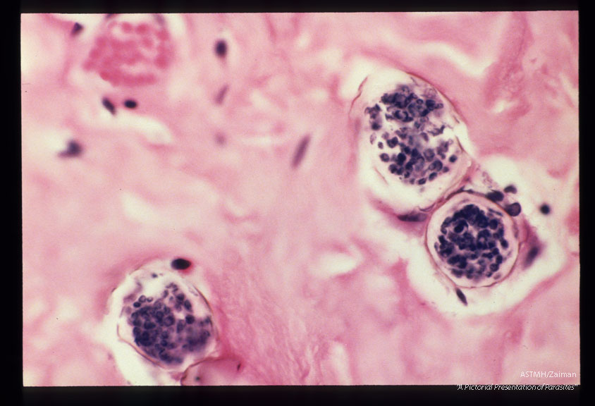 Fallopian tube with granulomata containing parasite eggs.