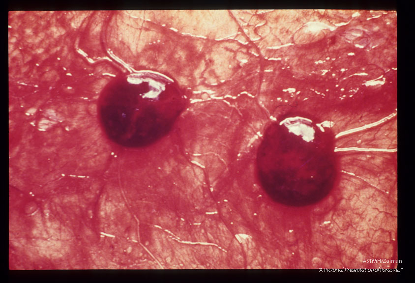 Infected fetal cotyledon.