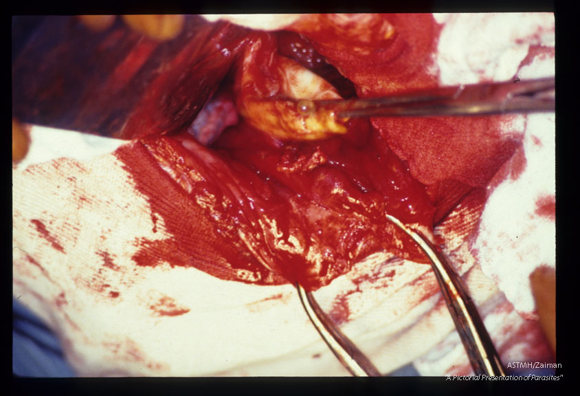 A 26 year old Italian male presented with jaundice due to biliary tree obstructions by daughter cysts of Echinoccocus granulosus. Picture sequence of operative dissection. Removal of cysts, placement of multiple drains and creation of several anastomoses were required to ensure proper biliary drainage and to prevent bile peritonitis.