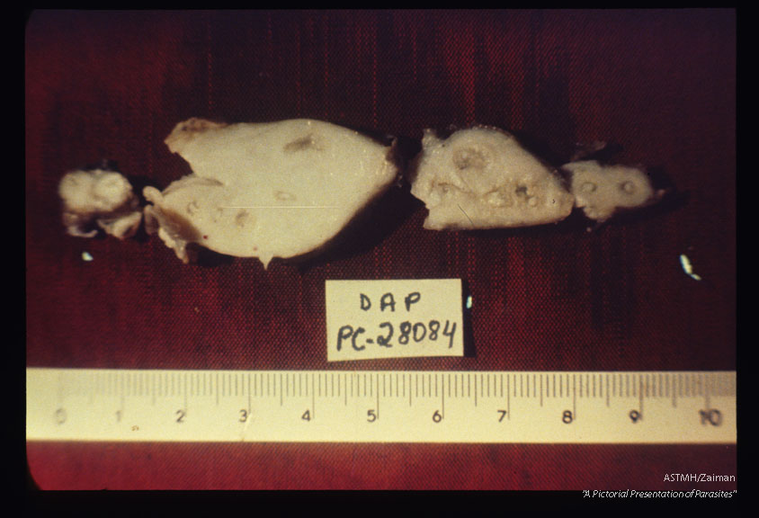 Abdominal mass which contained adult Ascaris (1407, 1408) and eggs (1409) was surgically removed from a patient. There was direct communication with the large bowel. Note cell division in the egg (1409).