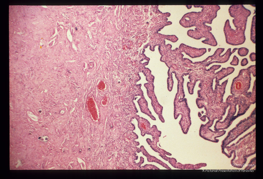 Fallopian tube with granulomata containing parasite eggs.