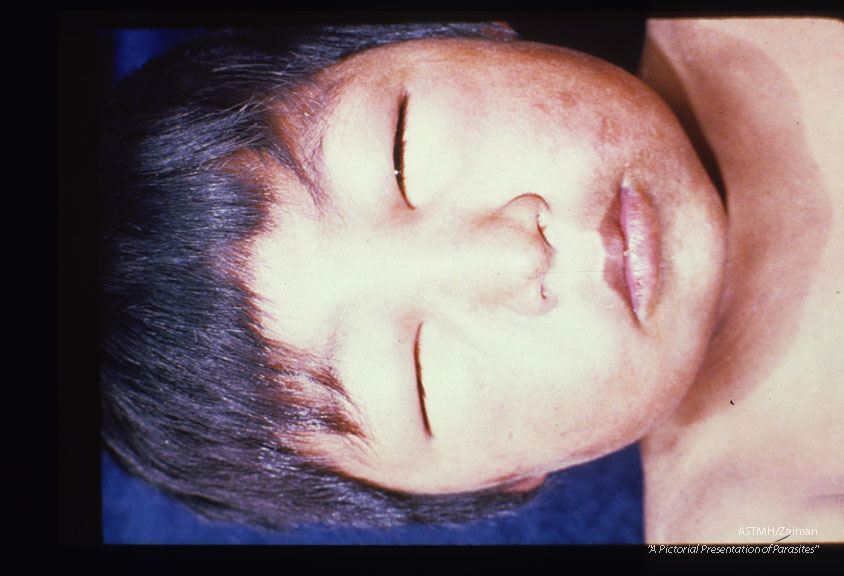 Mazzotti reaction in a Mexican child with facial edema and rash over deltoid region of the arm.