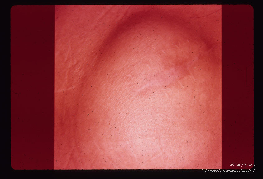 Close up view of same cyst showing old surgical scar. On previous occasions this cyst was drained and irrigated with cytoxan or leucanthone with no improvement.