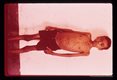 Splenomegaly.