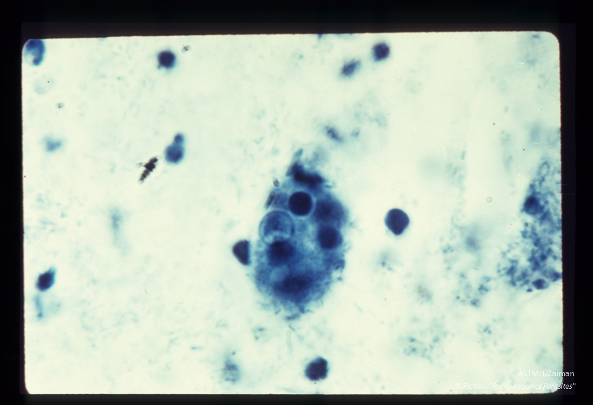 Trophozoites . iron hematoxylin stain. Each specimen has engulfed red blood cells which stain darkly.