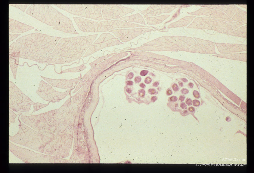 Hydatid cyst in agouti muscle.