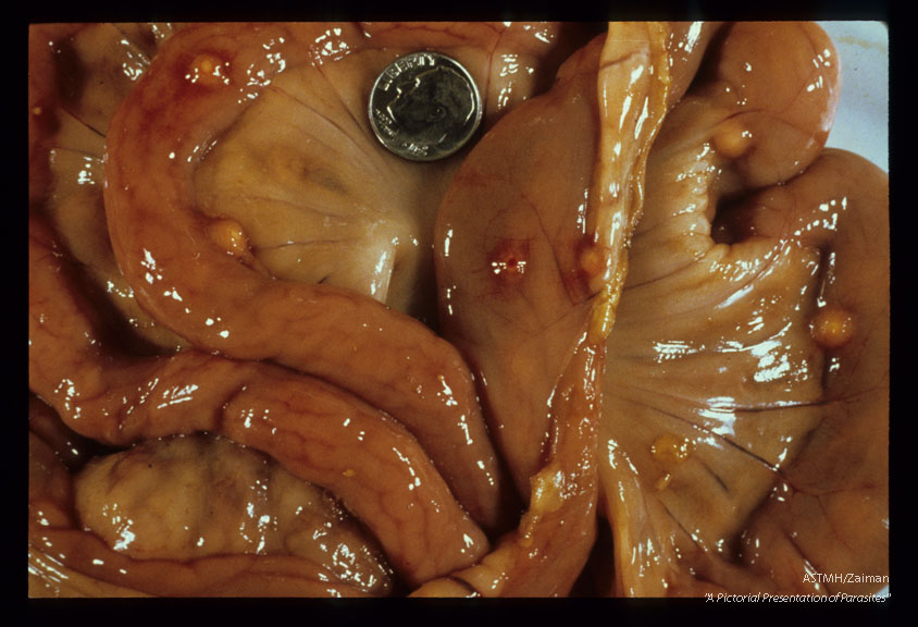 Gross view of opened hog abdomen showing multiple caseous nodules formed in response to worm attachment in the gut