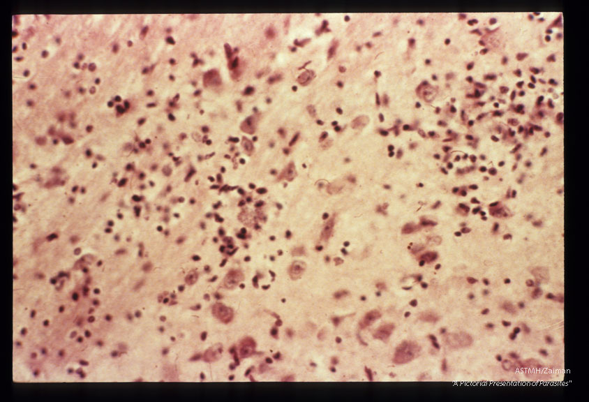 Cardiac muscle showing parasites, inflammatory response, loss of myocardial fibers and fibrous replacement.