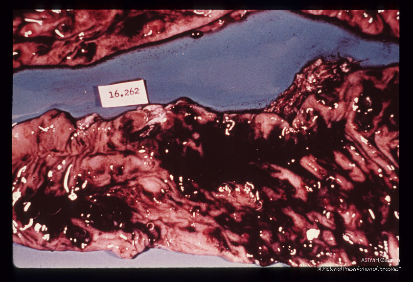 Trichuris tichiura, Balantidium coli,Entamoeba histolytica. Autopsy specimen showing adult helminths, ulcerations and bloody intestinal contents.