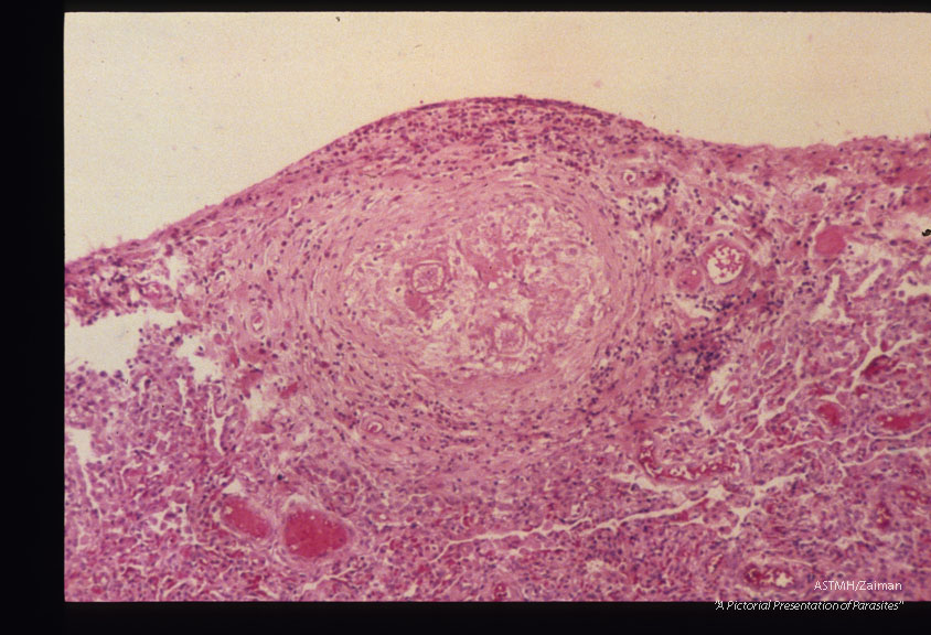 Same case. Subpleural pulmonary granuloma with larva.