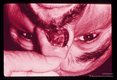 Destruction of nasal septum.