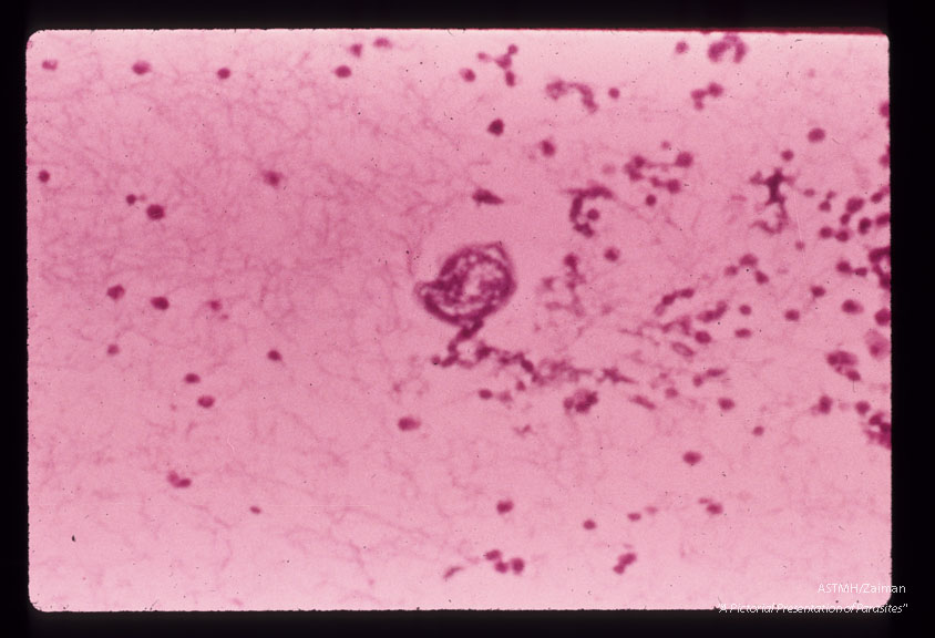 Cross section through larva found in pleural effusion of patient in Mt. Kisco, New York.