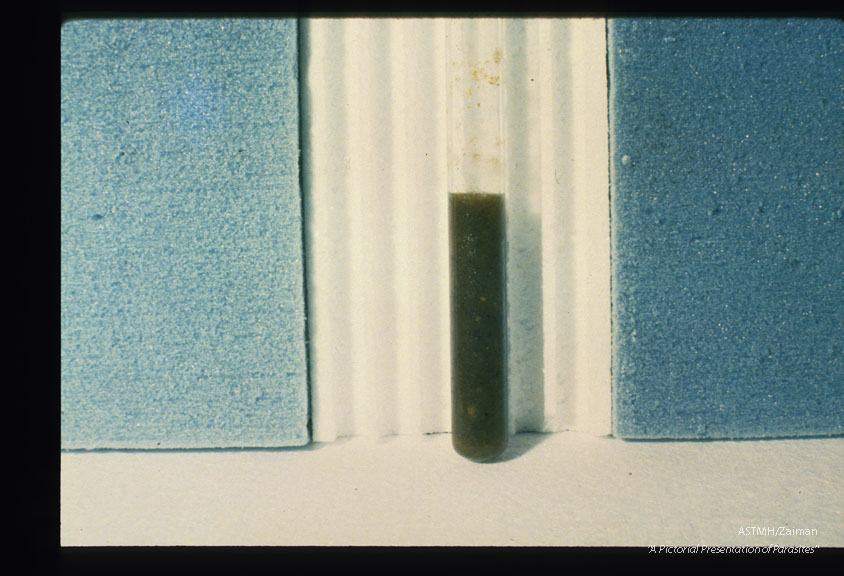 Cyst fluid drained from same patient April 14, 1965. Fluid was gelatinous and paniculate.