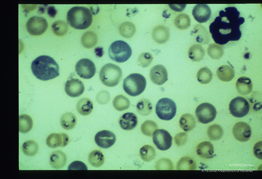 Giemsa stained slides from a fatal case on Fire Island, N. Y., (1982). The parasitemia is high for human babesiosis. Budding, multiply-infected erythrocytes, tetrad formation, band forms, reticulocytosis and clumping of extracellular parasites may be seen.
