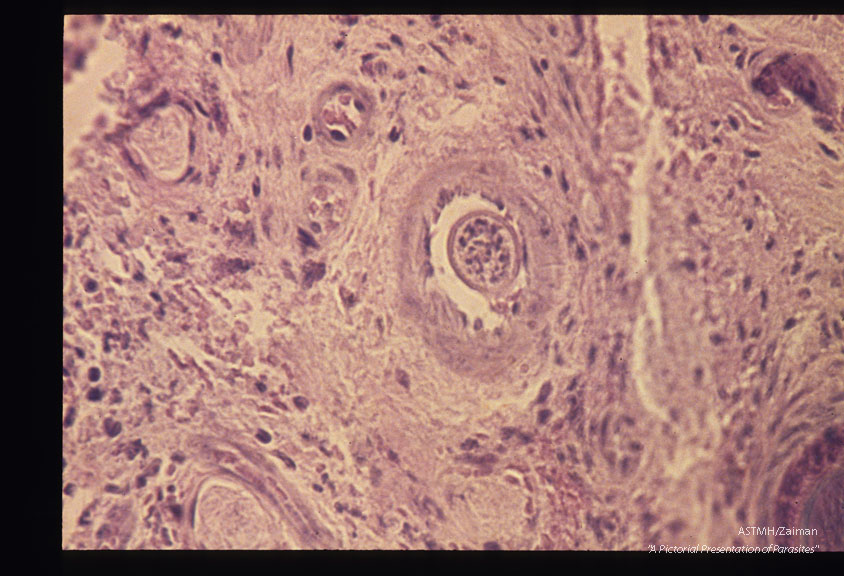 Parasite in a caudal artery.