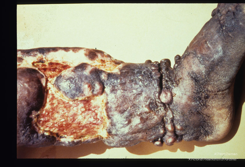 Elephantiasis, penetrating ulceration, heavy verrucal hyperkeratosis ("mossy foot"), and nodules on the left leg of a seventy-four year old male. Close-up slide shows the back of the leg just above the heel. Swelling began thirty years ago and ulceration nine years ago. Skin is armor-like and cracked in places. Leg is foul smelling and oozes a material like purulent lymph.