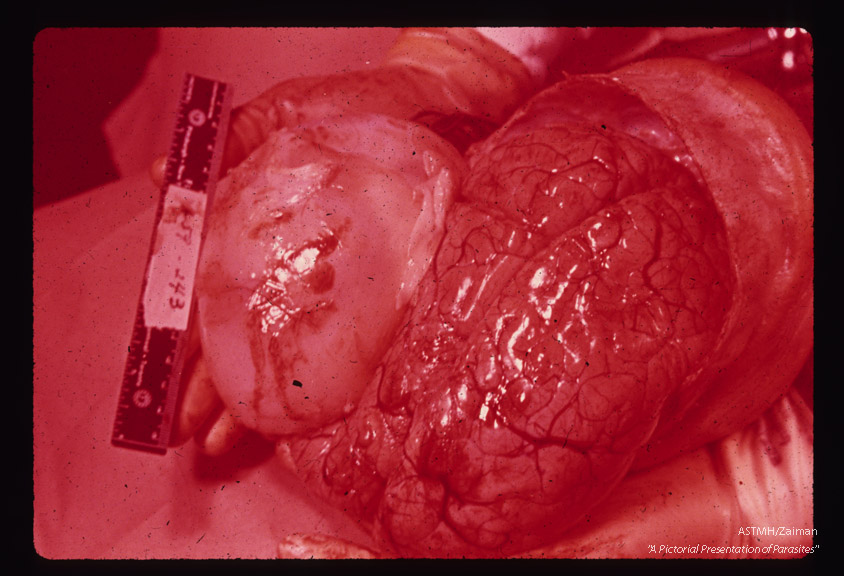 Cyst in brain. Photograph of seven year old Italian-born female who fell down five steps and shortly thereafter became unconscious for a few seconds. Vomited for a week. One month later she developed convulsions, head­aches, and intermittent drowsiness. A few hours prior to hospitalization, she vomited (nonprojectile), convulsed, complained of pain in the neck and became drowsy. Physical examination showed neck stiffness, hyperactive knee jerks, positive Kernig and Babinski reflexes. The patient went into a deep coma with occasional involuntary motions and died two days after admission. At autopsy, a 250 gram, 10 x 5 cm,, white-walled cyst bulged through the gray matter of the left cerebrum. Subsequent microscopic examination of the cyst wall revealed typical scolices of Echinococcus granulosus.