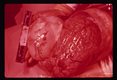 Cyst in brain. Photograph of seven year old Italian-born female who fell down five steps and shortly thereafter became unconscious for a few seconds. Vomited for a week. One month later she developed convulsions, head­aches, and intermittent drowsiness. A few hours prior to hospitalization, she vomited (nonprojectile), convulsed, complained of pain in the neck and became drowsy. Physical examination showed neck stiffness, hyperactive knee jerks, positive Kernig and Babinski reflexes. The patient went into a deep coma with occasional involuntary motions and died two days after admission. At autopsy, a 250 gram, 10 x 5 cm,, white-walled cyst bulged through the gray matter of the left cerebrum. Subsequent microscopic examination of the cyst wall revealed typical scolices of Echinococcus granulosus.