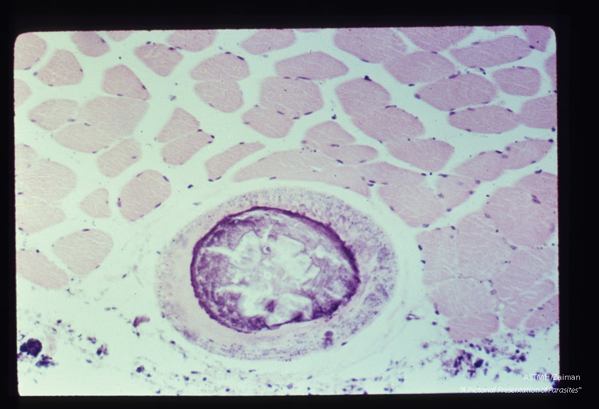 H and E. Old cyst undergoing degeneration in muscle.