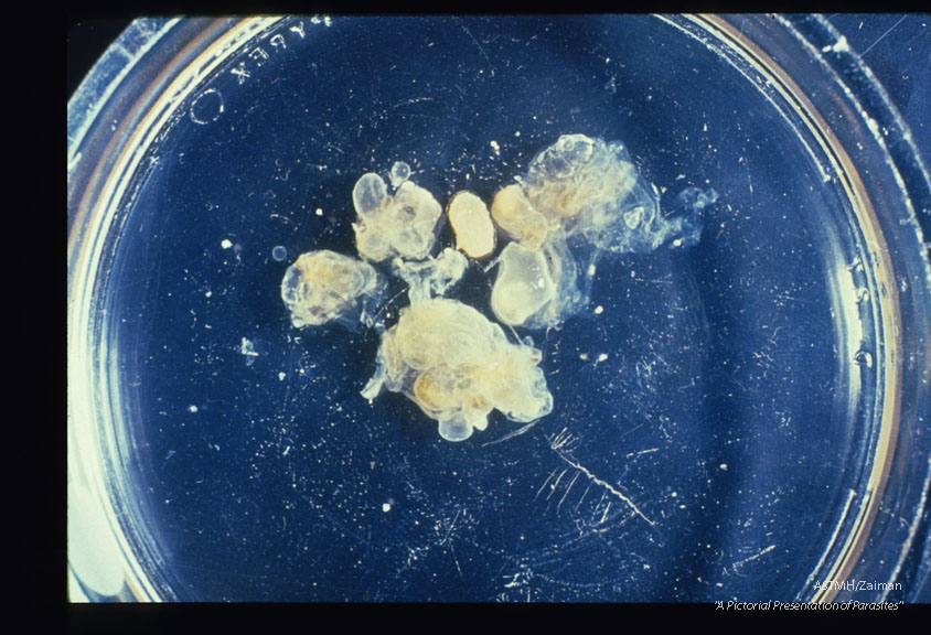 Multi-chambered hydatid cyst from first case described in Panama.