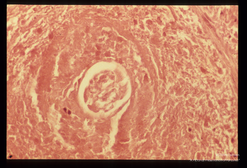 Low power view of same parasite. H&E stain.