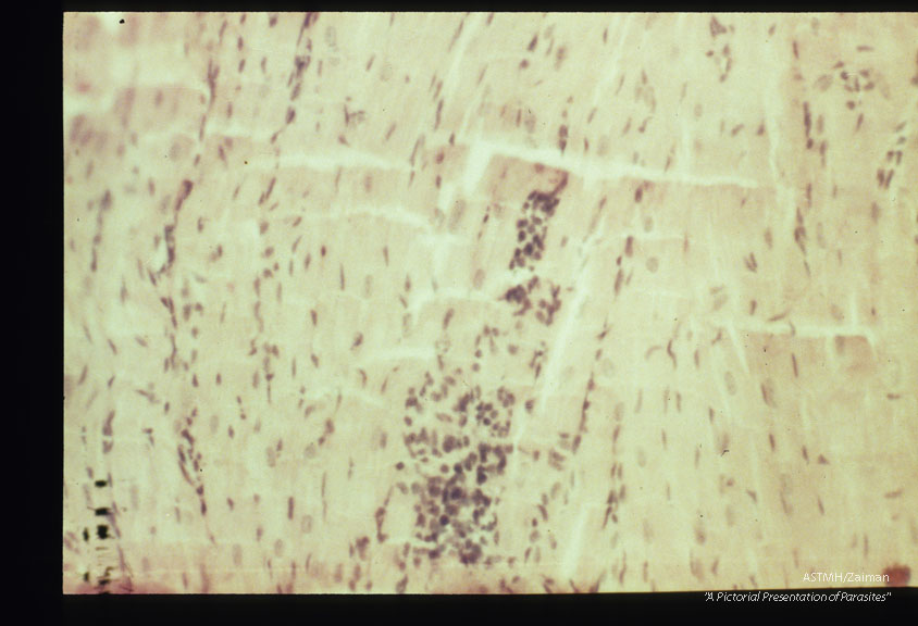 Focal myocardial lesions at low and high powers. Experimental trichinous myocarditis in rats.