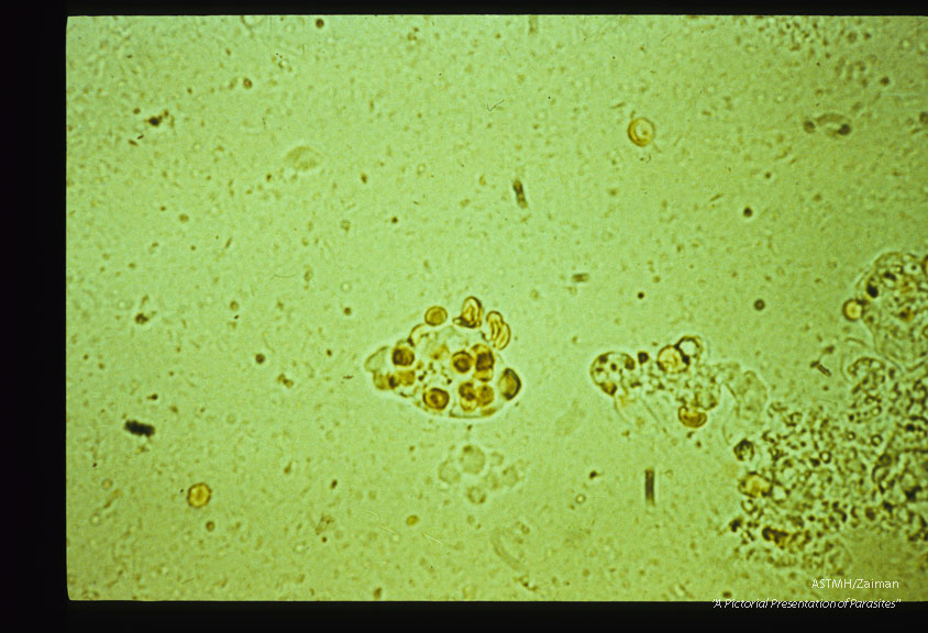 Unstained stool smear containing a hematophagous trophozoite.