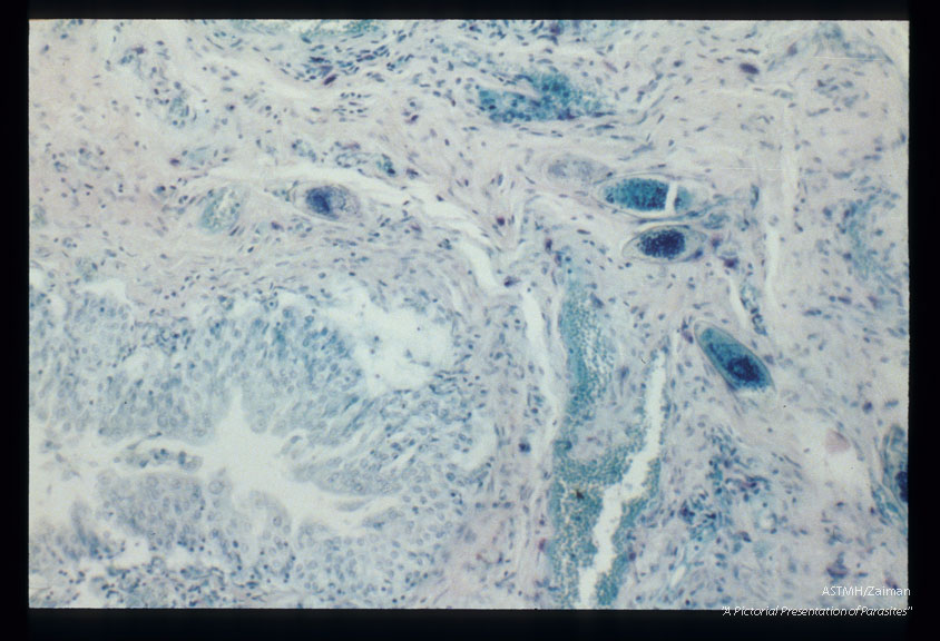 Bladder biopsies from an Egyptian.