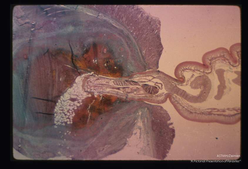 Proboscis attached to pig bowel wall. The insertion of the toothed proboscis, the inflammation, ulceration and hemorrhage caused are seen in this low power view.