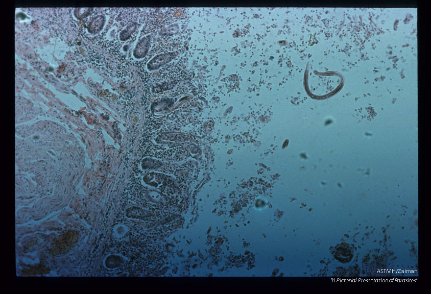 Fatal case in institutionalized child. Low power view showing adult in lumen of bowel.