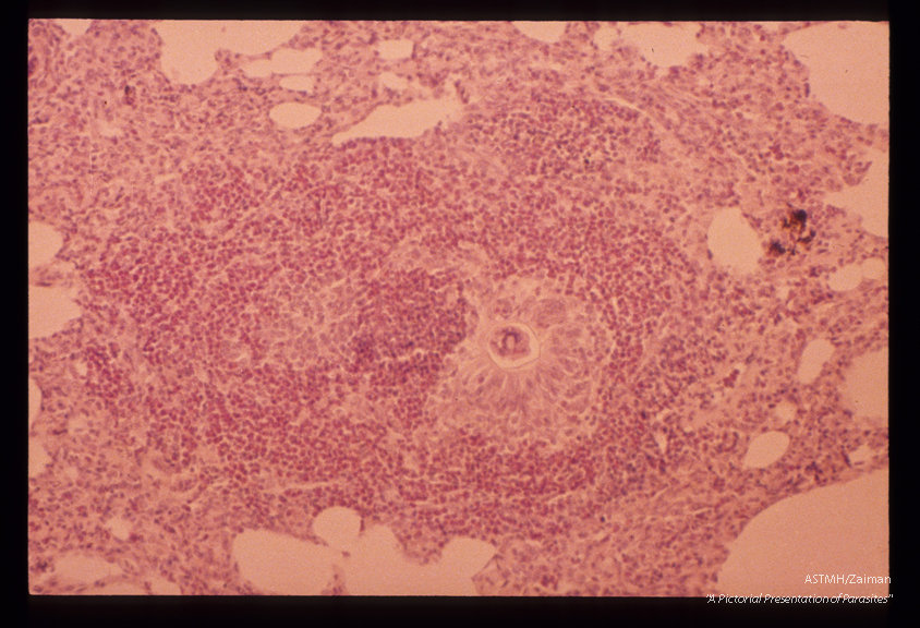 Egg in monkey lung. A granuloma containing an egg shell is seen in the lung. Note the marked esosinophilic infiltrate.