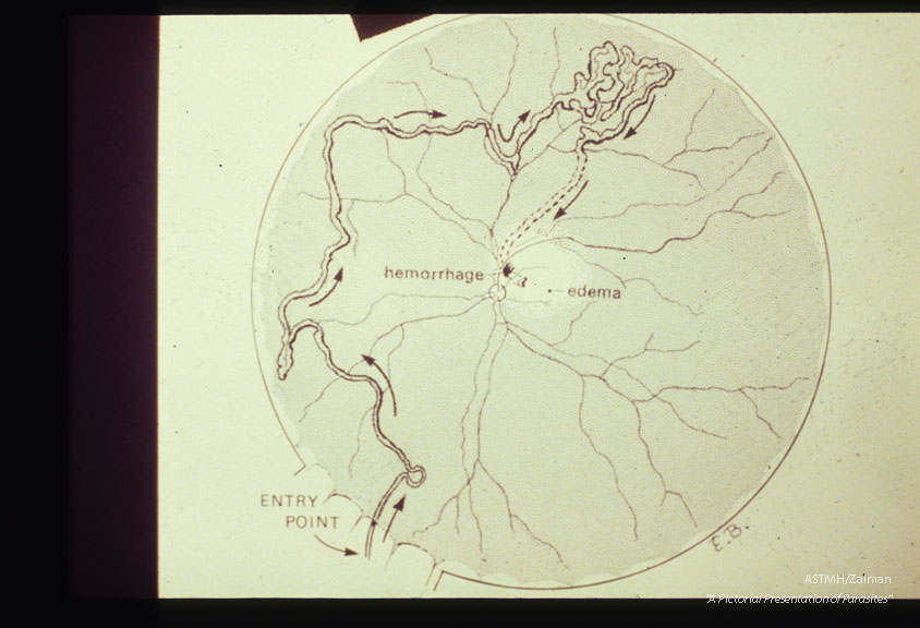 In human eye. Part of pigmented track resulting from migration of trematode.