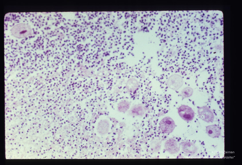 Low and high powered views of trophozoites within inflamed appendix. (H&E).