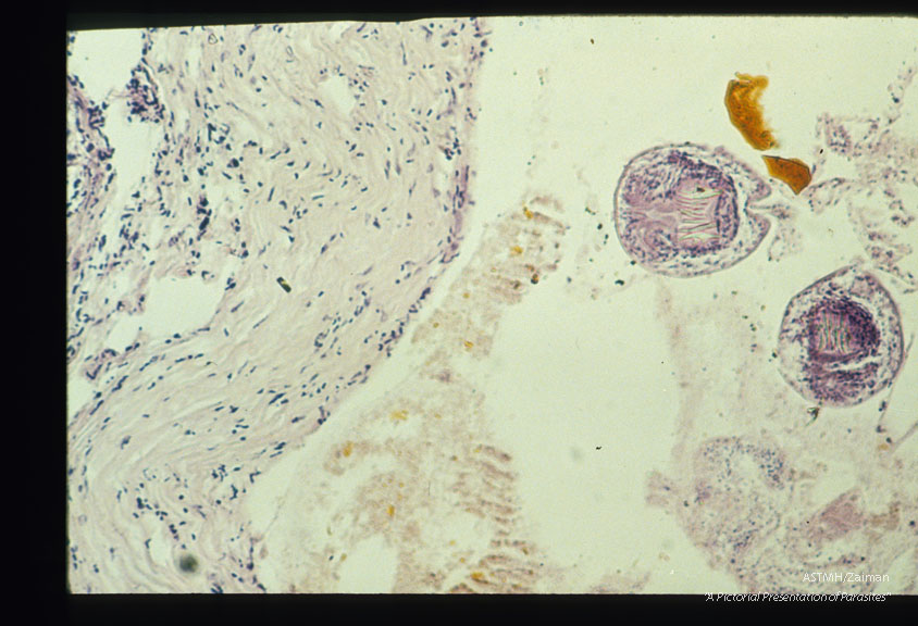 Biopsy material from same case.