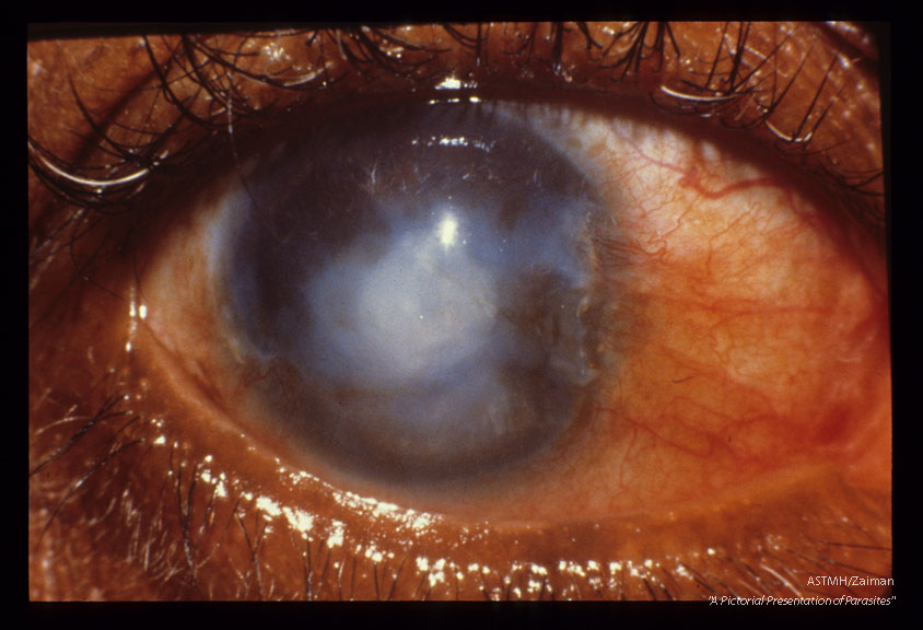 Advanced sclerosing keratitis in a 52 year old Guatamalan male. The inferior two thirds of the cornea are opaque and vascularized. There is a pigmentation line extending across the limbus onto the cornea.