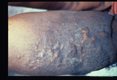 Elephantiasis, hyperkeratosis and nodule like fibres is on the lower right leg of a sixty-eight year old female. The case was aquired thirty years earlier. Patient claimed cosmetic surgery on this leg thirty years ago, but incision scars could not be identified.