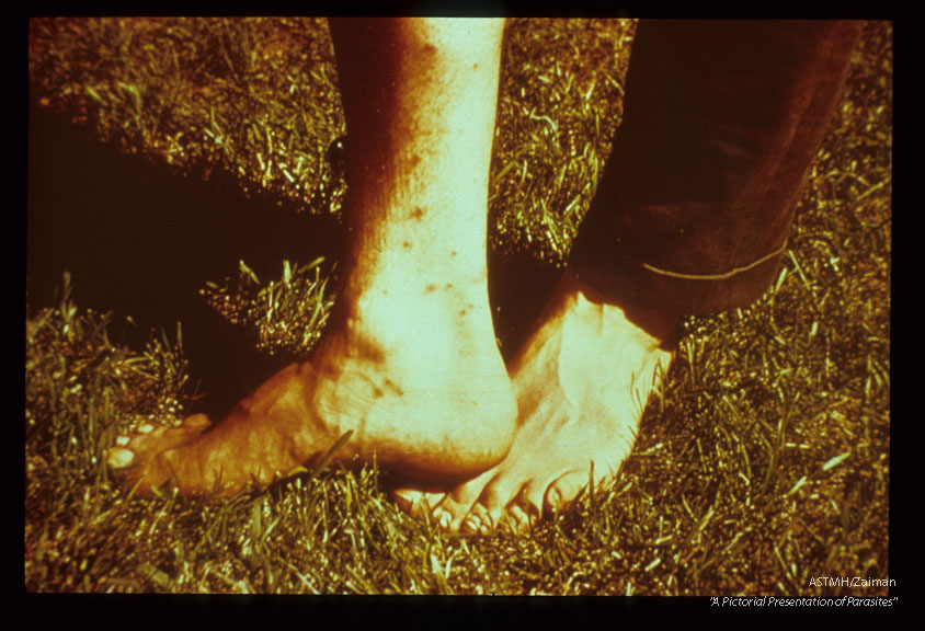 Swimmer's itch caused by non-human schistosome cercarial penetration of human skin. One of the schistosomes responsible for swimmer's itch in certain areas of North America.