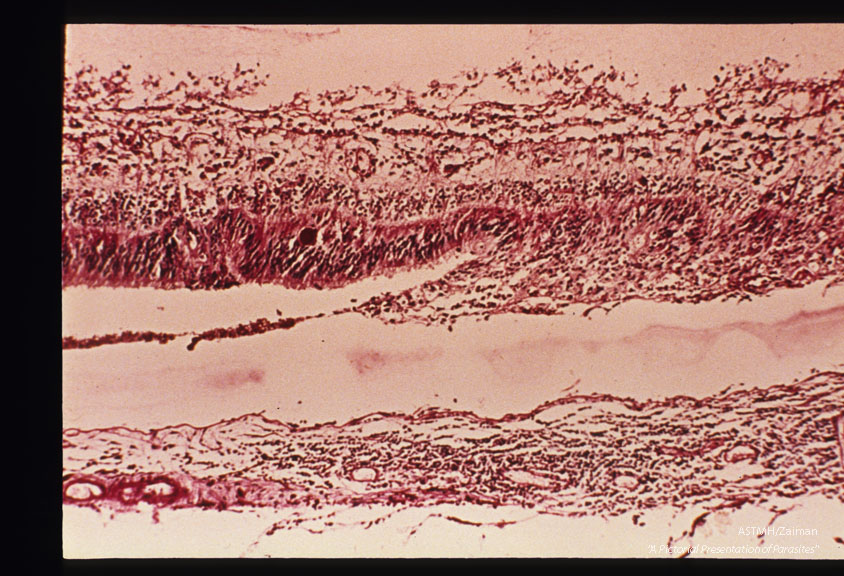 Toxoplasmic retinochoroiditis with Toxoplasma cyst. Presumably this lesion resulted from cyst rupture.