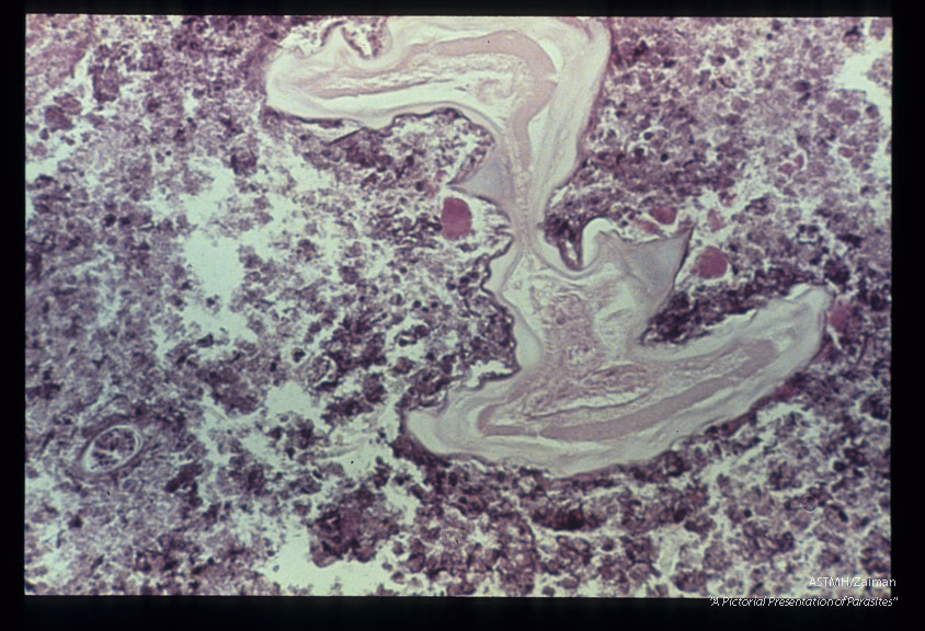 Low and high power views of parasite in pulmonary nodule.