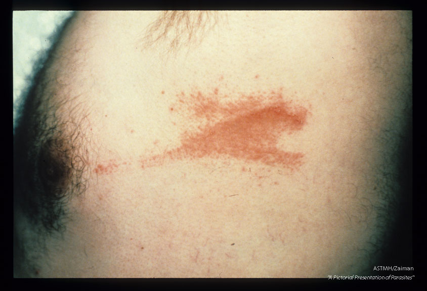 Rash induced by migration of a caterpillar over the skin of a missionary physician in Liberia. The caterpillars usually fall from trees.